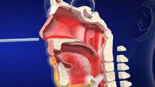 Nasogastric eLearning from Vygon UK Ltd [upl. by Leihcey]