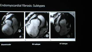 Lecture 7 Diseases of the myocardium Part II [upl. by Nadnarb]