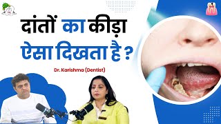 दांतों में कीड़ा लगने से बचने के उपाय  Dr Karishma  Pyria Treatment  Oral Health in Hindi [upl. by Enirroc945]