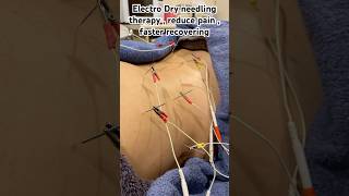 Electro Dry Needling reducepain musclespasm chronicpain sportinjury dryneedling myotherapy [upl. by Llerrot]