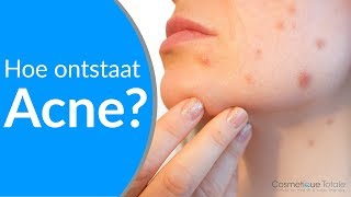 WAT IS ACNE HOE ONTSTAAT ACNE en hoe kan je acne voorkomen [upl. by Jeffie]