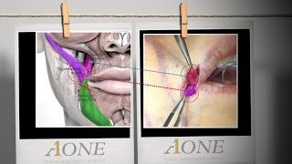 How to perform Smile Lipt Mouth corner lifting procedure and its effectiveness [upl. by Arly]