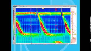 Esophageal Motility Disorders Part 1 [upl. by Llerraj]