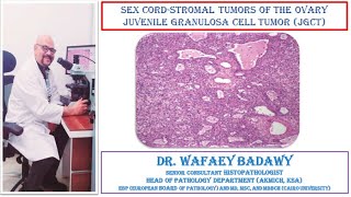 SEX CORD STROMAL TUMORS OF THE OVARY JUVENILE GRANULOSA CELL TUMO BY DR WAFAEY BADAWY [upl. by Lail]