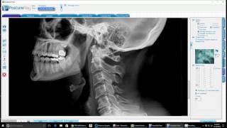 Orthospinology Lateral Cervical Analysis Dr Bo Rochester [upl. by Otinauj]