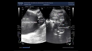 Understanding the different types of Ovarian Cysts [upl. by Rangel]