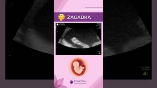 Zagadka z USG ciąży 🤰 ciąża USG5D usgciążywarszawa [upl. by Isaiah953]