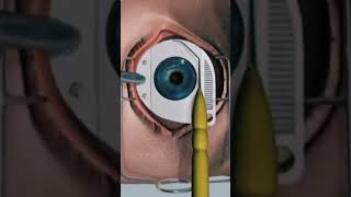 LASIK eyes surgery 3D Animation nursing doctor nursingliveclasses short video [upl. by Hole]