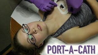 HOW TO ACCESS A PORTACATH IMPLANTED PORT [upl. by Thevenot109]