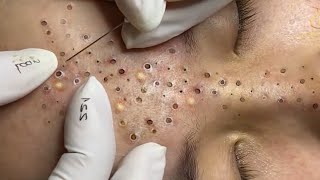 Relax Skincare Everyday with Acne Blackheads Treatment Spa 97998 [upl. by Narah]