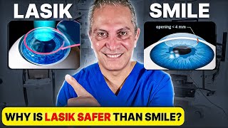 Should you Choose LASIK or SMILE Eye Surgery Eye Surgeon Explains [upl. by Melita]