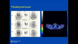 Basics of Multiple Endocrine Neoplasia [upl. by Carling646]