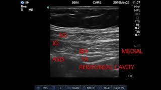 usg GUIDED Ilioinguinal amp IliohypogastricIIIH nerve block [upl. by Ivad]