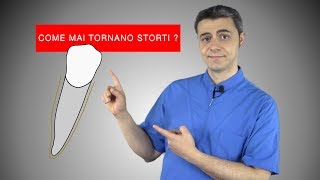 Come lapparecchio allinea i denti e perché tornano storti [upl. by Mongeau]