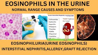 EOSINOPHILS IN URINENORMAL RANGE CAUSES OF EOSINOPHILS IN URINELYMPHOCYTES MONOCYTES IN URINE [upl. by Limoli]