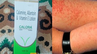 CALORA lotion calamine Allantoin amp vitamin E lotion review [upl. by Brownson]