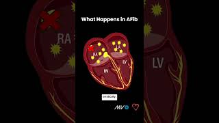 Process of AFib in Your Heart [upl. by Larisa]