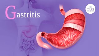 What is Gastritis  Causes Symptoms Complications and Treatment  CARE Hospitals [upl. by Cassiani589]