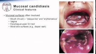 Candida Mucosal candidiasis [upl. by Gnof]