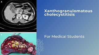 Xanthogranulomatous cholecystitis neetpg fmge usmle [upl. by Wolsky]