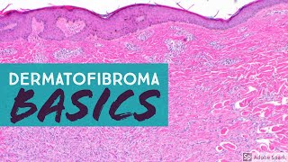 Dermatofibroma 101 Benign Fibrous HistiocytomaExplained by a Dermatopathologist [upl. by Suoicserp]