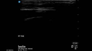 Rib Ultrasound Subluxation at the Costochondral Junction Short Axis [upl. by Rosamund969]