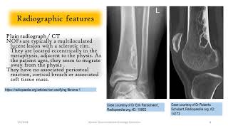 Non ossifying Fibroma NOF [upl. by Zechariah]