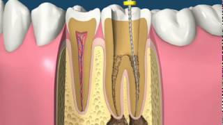 ROOT CANAL TREATMENT TAMIL MADURAI [upl. by Rudyard]