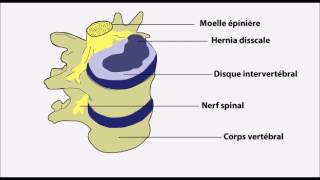 Hernie discale prolapsus discal [upl. by Annirok]