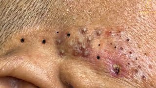 Remove Blackheads and Pimples Popping At HT Spa 38 [upl. by Hodosh]