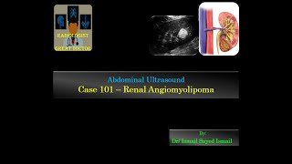 Ultrasound Case 101  Renal Angiomyolipoma [upl. by Rutger754]