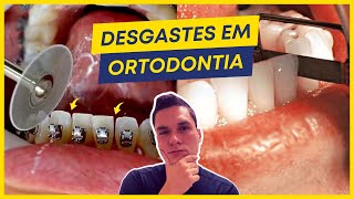 DESGASTES INTERPROXIMAIS EM ORTODONTIA SLICES QUANDO SE DEVE FAZER [upl. by Eziechiele]