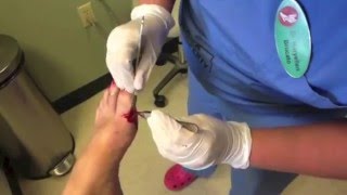 Surgical Removal of Ganglion Cyst [upl. by Ripp]