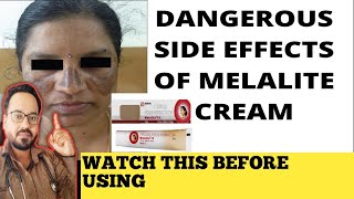 Melalite Cream Review  इस क्रीम का इस्तेमाल ना करें [upl. by Annahavas28]