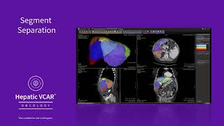 Hepatic VCAR overview [upl. by Traci]