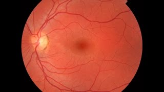 Practical Ophthalmology  Retina and Optic Nerve [upl. by Keir11]