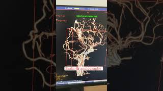 CT BRAIN ANGIOGRAPHY NIDUS AVN [upl. by Benge]