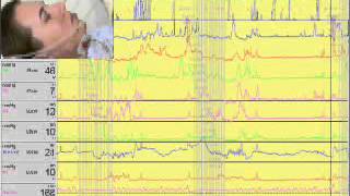 Video 1  Performing esophageal manometry [upl. by Navaj544]