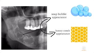 Ameloblastoma part 1 [upl. by Schlenger]