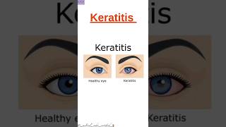 Keratitis Shorts Disease CPC Exam Medical Coding and Billing [upl. by Notled329]