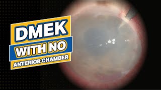 DMEK with NO Anterior Chamber [upl. by Hilliary]