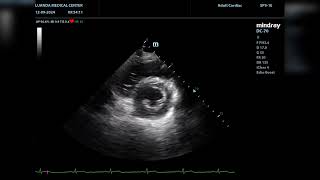 Echocardiographic presentation of loose chordae tendineae versus tertiary chordae rupture [upl. by Baxter]