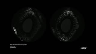 Iris Fluorescein Angiography [upl. by Mattson]