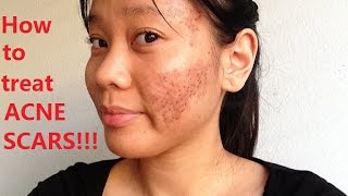 How to treat Acne Scars [upl. by Sofer581]