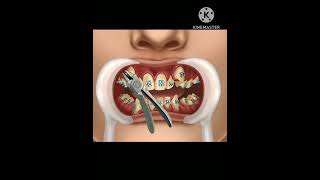 how are braces put on orthopaedic surgery orthodox animation dentist dental orthodontics viral [upl. by Areyk]