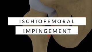 Ischiofemoral Impingement  A Nonsurgical Overview [upl. by Bigod]