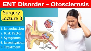 Otosclerosis  ENT Disorder  Surgery Lacture  Free Notes [upl. by Llednil]