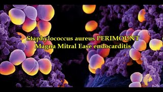 Staphylococcus aureus PERIMOUNT Magna Mitral Ease endocarditis [upl. by Niltac314]