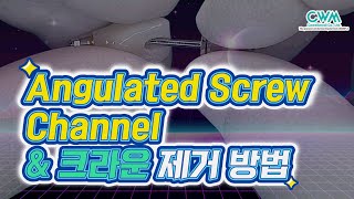 SFIT HandsOn Angulated Screw Channel amp 크라운 제거 방법 [upl. by Leroi348]