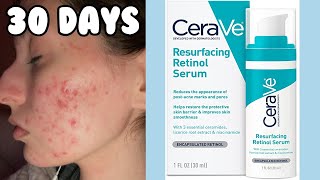 I TRIED THE CERAVE RESURFACING RETINOL SERUM FOR MY ACNE  1 Month Test [upl. by Wadell]